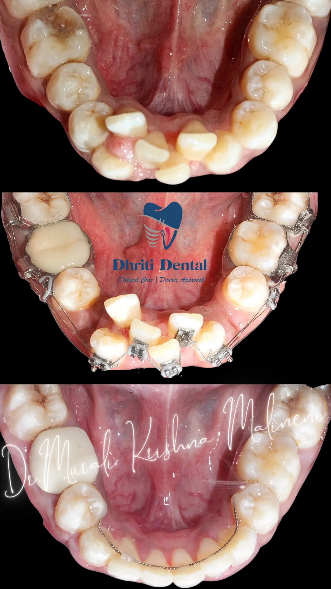 Braces Treatment